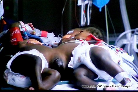 Haiti Medical FIRST - Conjoined twins separated at Mirebalais University Hospital 1